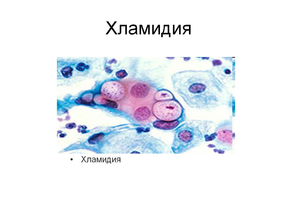 Хламидиоз презентация медицина